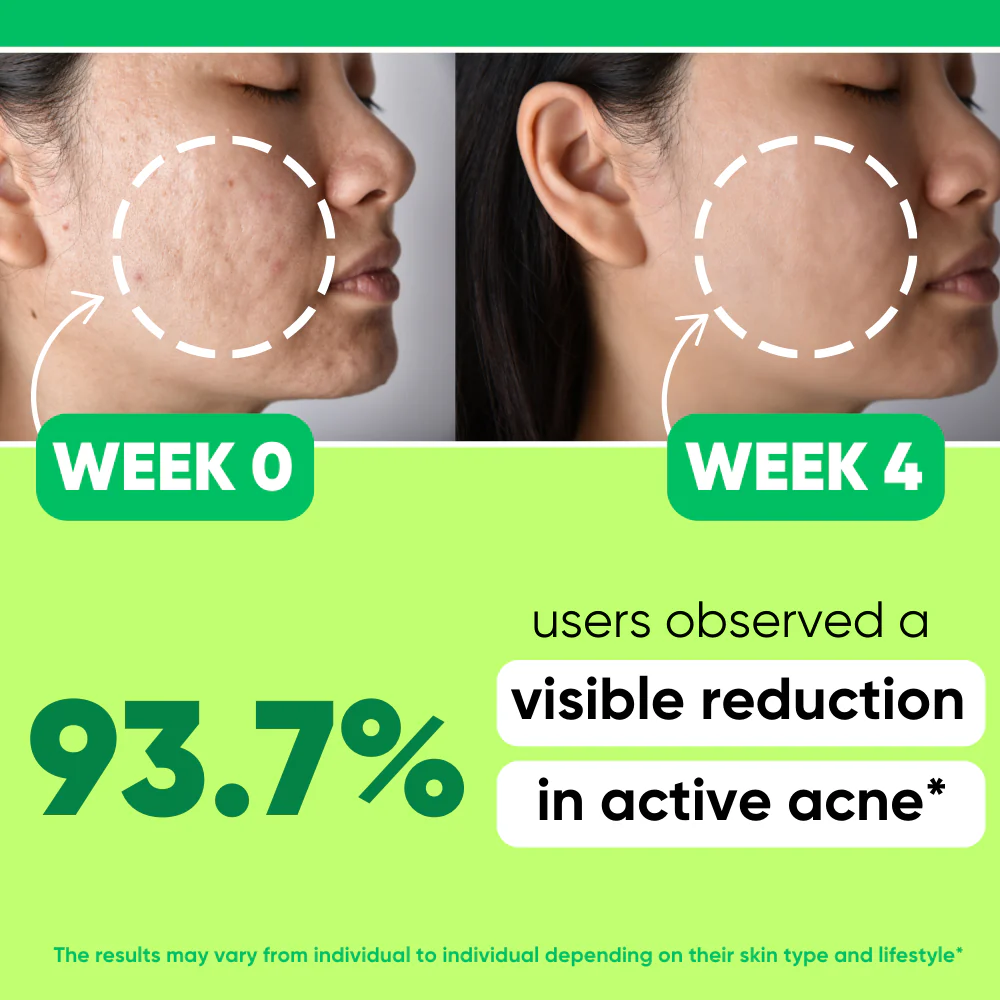 2% Salicylic Acid + Green Tea Extract Face Serum | Acne Treatment & Pore-Clearing | Clear Skin Serum | 30ml - Image 4