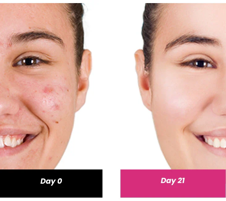2% Salicylic acid Serum, 30ml - Image 4