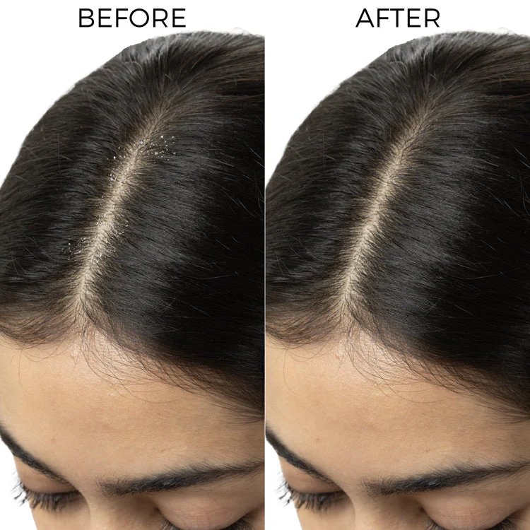 Complete Dandruff Control Kit for Itchy Flaky Scalp - Image 7