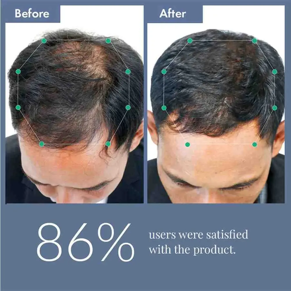 Hair Growth Serum 2.0 For Men & Women, 50ml + Free Rosemary Water Hair Spray, 100ml - Image 12