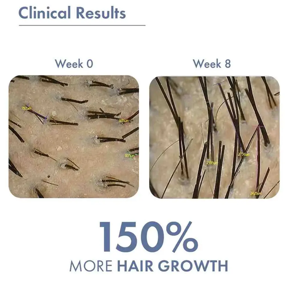 Hair Growth Serum 2.0 For Men & Women, 50ml + Free Rosemary Water Hair Spray, 100ml - Image 7