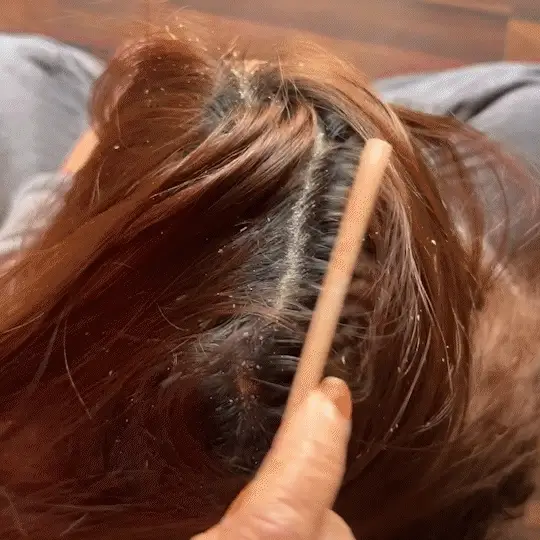 Instant Dandruff Removal Gel - Image 2