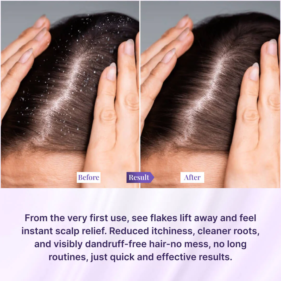 Instant Dandruff Removal Gel - Image 4