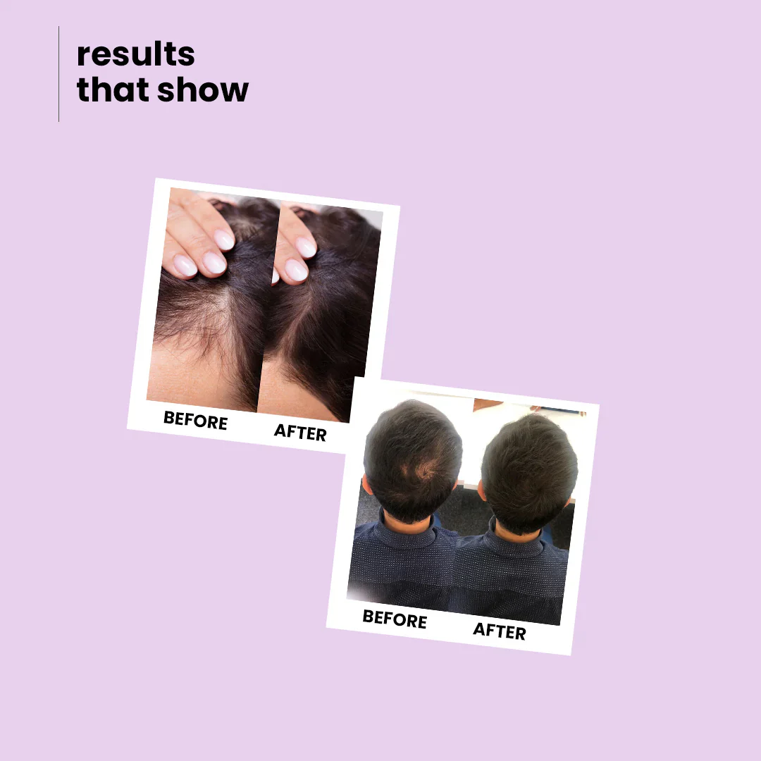 Onion & Rosemary Growth Boost Shampoo for Strong, Shiny Hair | 200 ml - Image 9