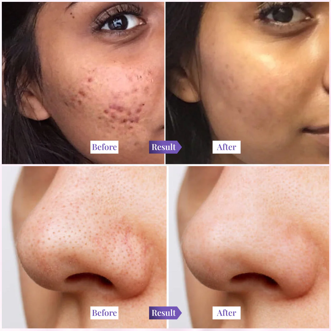 Sanfe Acne & Blackhead Clear Combo - Image 4