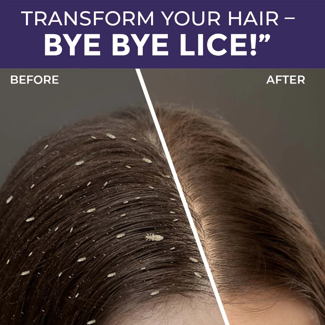 Sanfe Anti Lice and Dandruff Shampoo - Image 5
