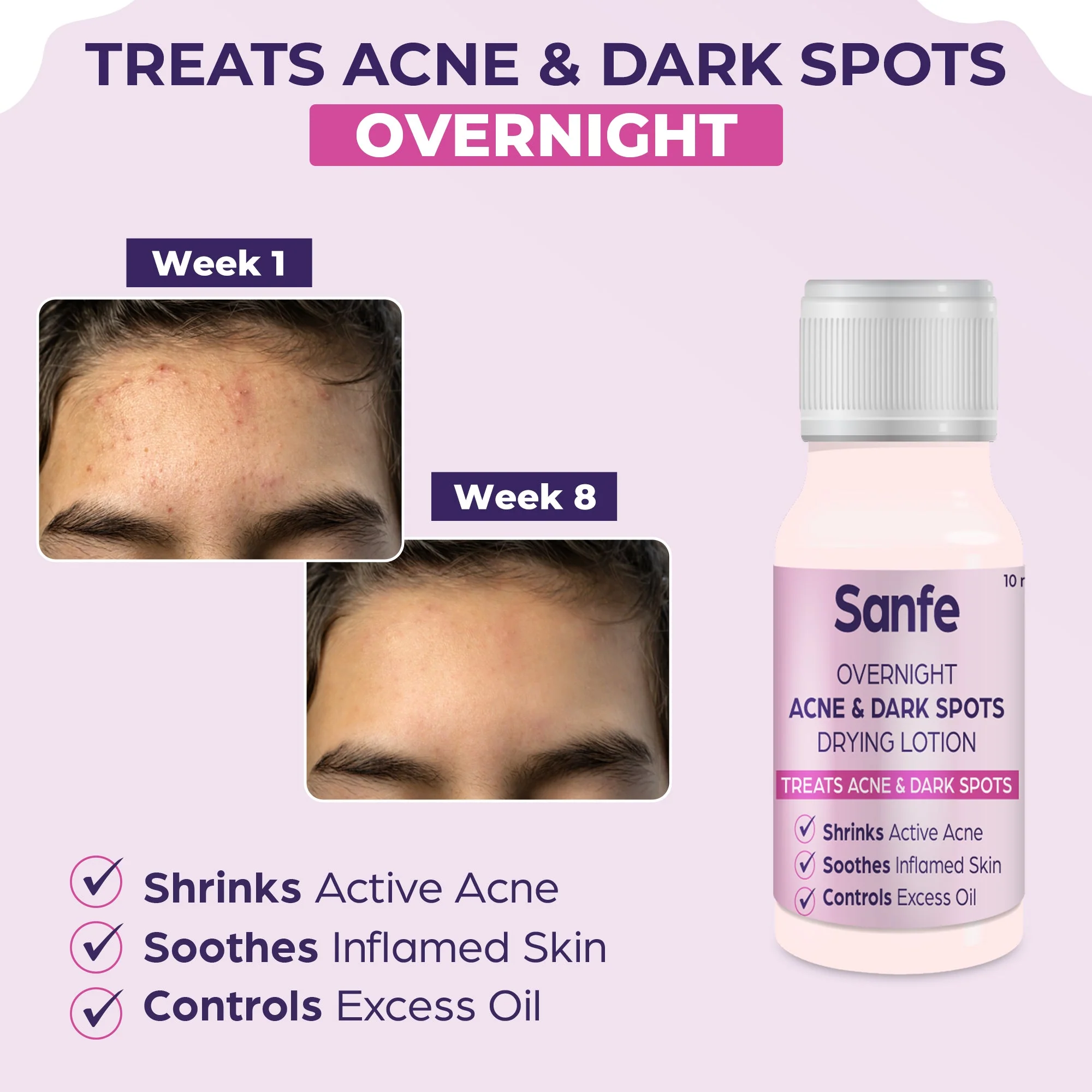 Sanfe Overnight Acne & Dark Spots Drying Lotion - 10ml - Image 3
