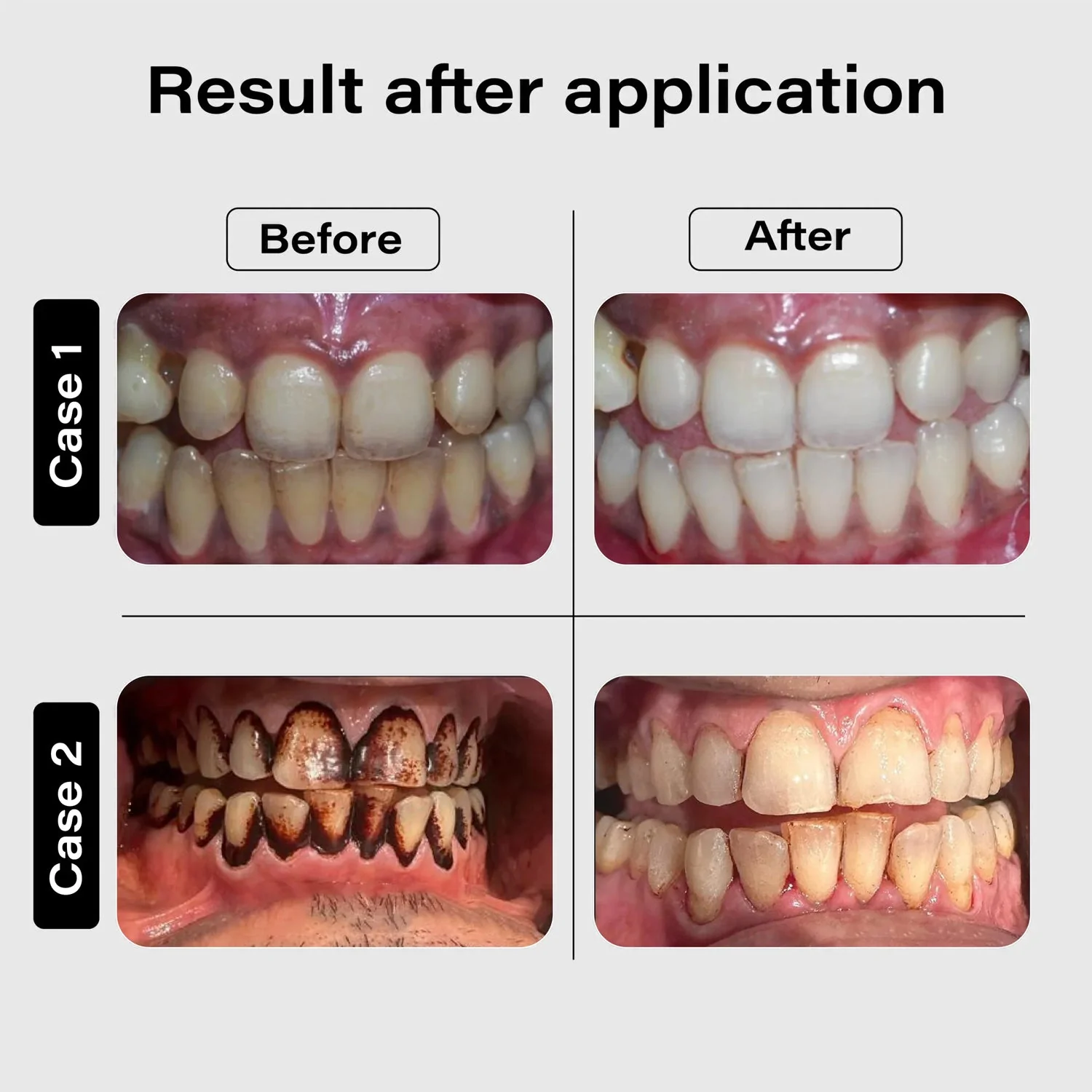 SmiloShine® Signature Teeth Whitening Ritual (3-in-1 Home Kit) - Image 8