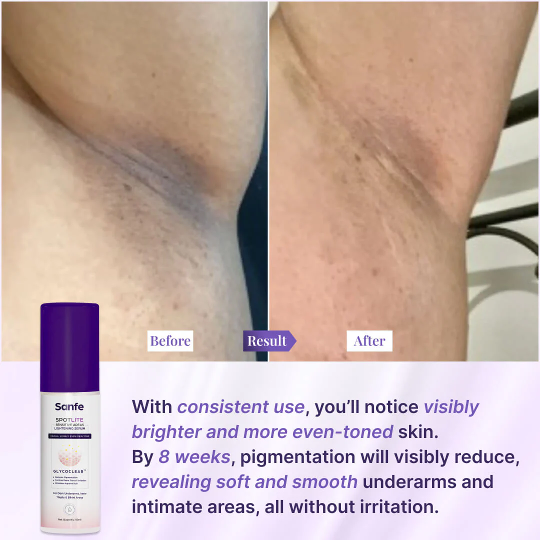 Spotlite Sensitive Areas Lightening Serum For Women - Image 5